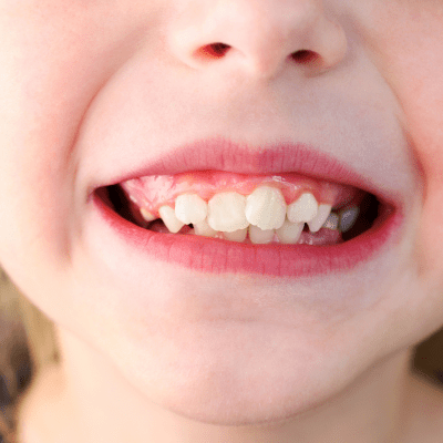 Patients Crowded Teeth In Epsom, Auckland